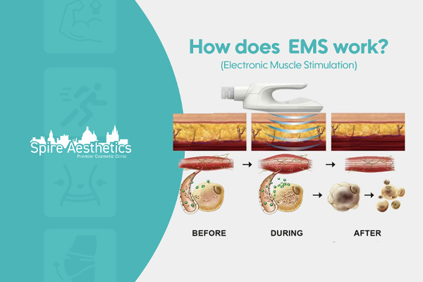 EMS treatment for post pregnancy weight loss treatment Langley