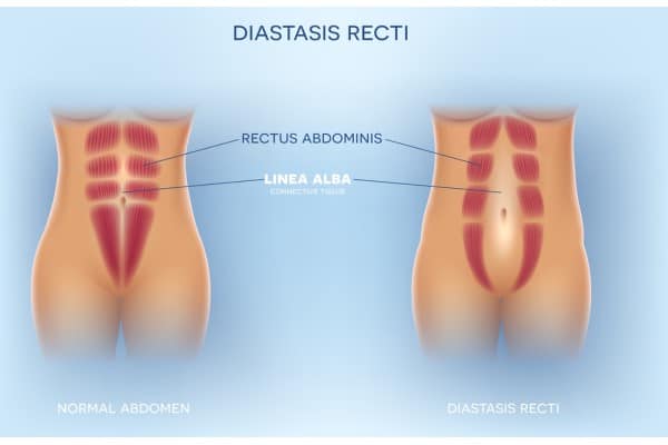 What Non-Surgical Options Are Available for Diastasis Recti Langley?