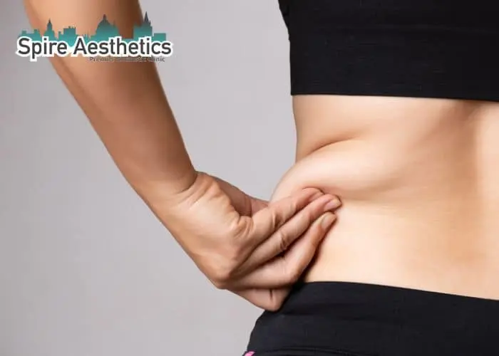 Image of woman pinching fat on their hips Langley. Fat Freezing treatment