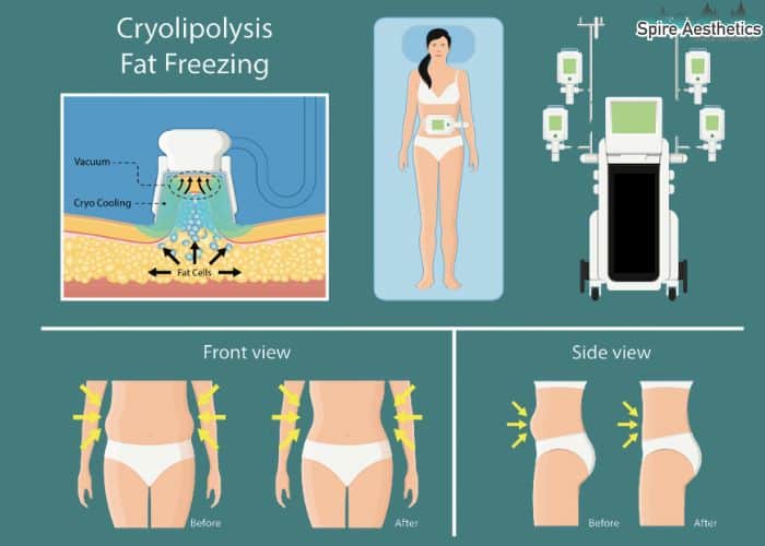 Image of diet and fat freezing combined for best results for Spire Aesthetics Langley