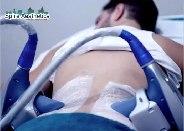 Man having fat freezing treatment done on love handles before a competitions Langley to create a sculpted look.
