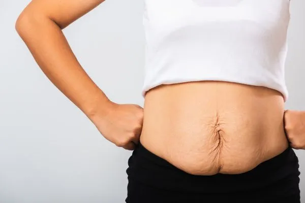 Image of a woman's stomach after weight loss with sagging skin following a gastric band Langley