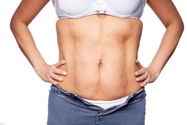 sagging skin on woman's stomach after weight loss injections Langley