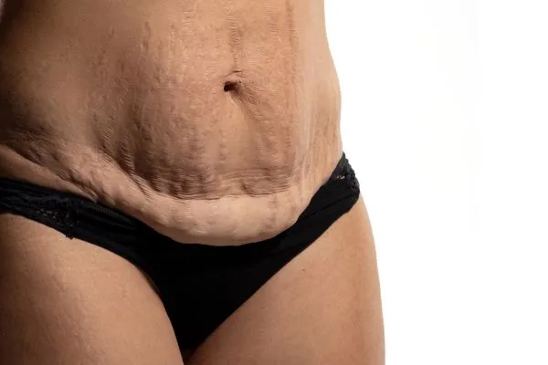 Image of womans stomach after weight loss injections Langley showing saggy skin