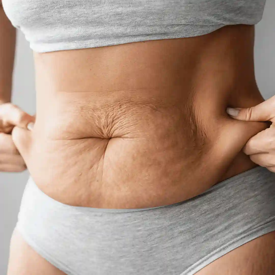 Is It Normal to Have Loose Skin After Pregnancy Langley?
