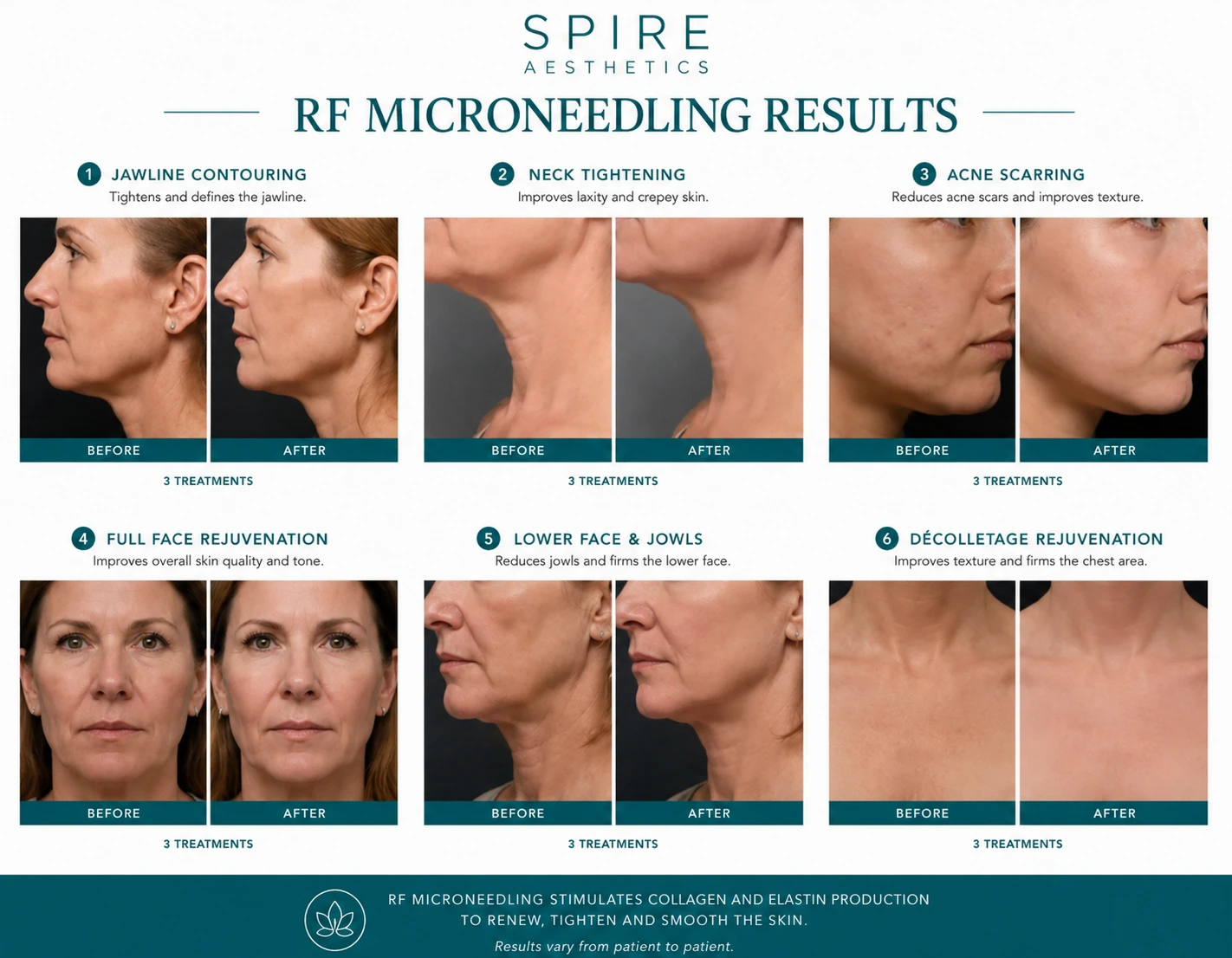 RF Microneedling Skin tightening Langley results