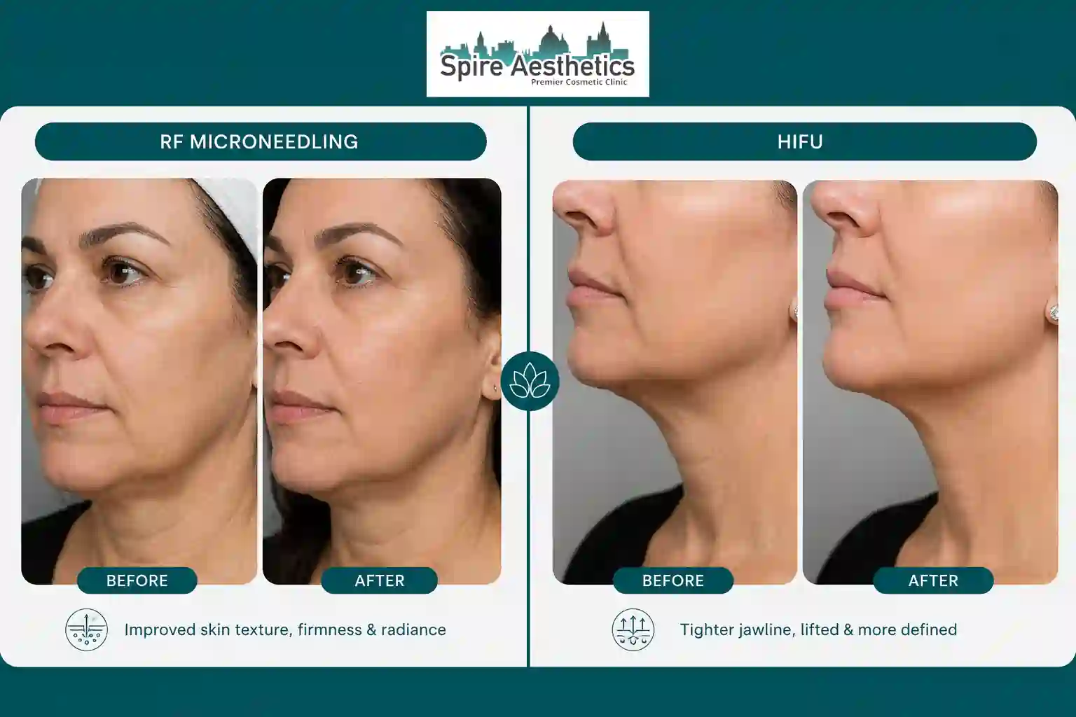 Can RF Microneedling and HIFU Be Combined Langley?