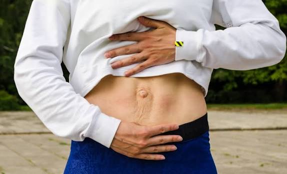 When Could Diastasis Recti Be the Missing Piece of the Puzzle Langley?