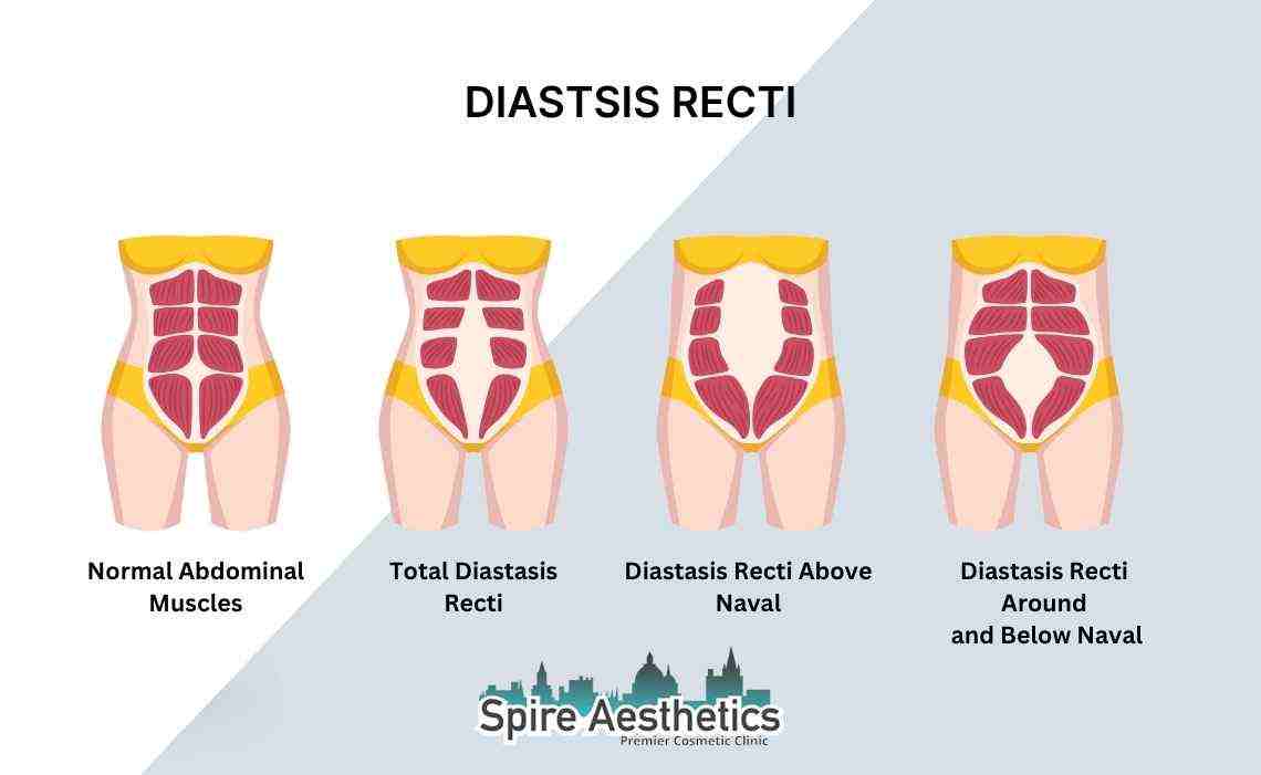 Is Non-Surgical Diastasis Recti Treatment Right for You? Common Concerns Answered Langley